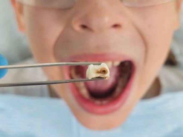 Best Emergency Treatment for Toothache in Perry, OK