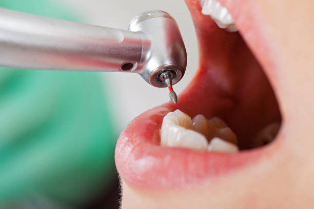 Best Emergency Wisdom Teeth Removal in Perry, OK
